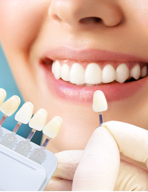 Imagem JPG, Tratamento - Clareamento Dental