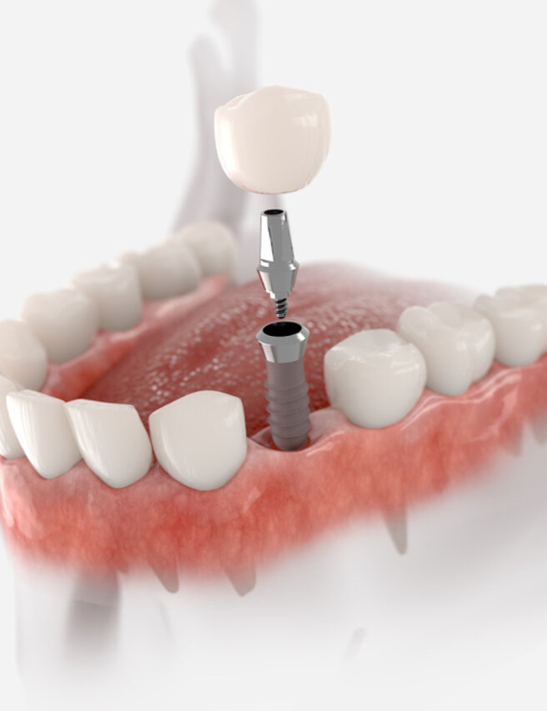 Imagem JPG, Tratamento - Implante Dentário